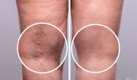 Alsó végtagi érszűkület kezelése és érelmeszesedés visszafordítása